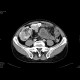 Crohn's disease with abscesses, fistulae, and sacroileitis: CT - Computed tomography